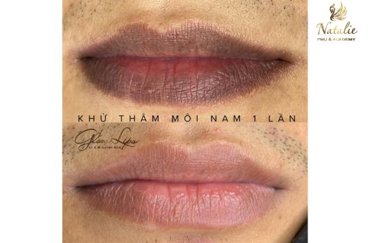 cach-tri-tham-moi-cho-nam (3)